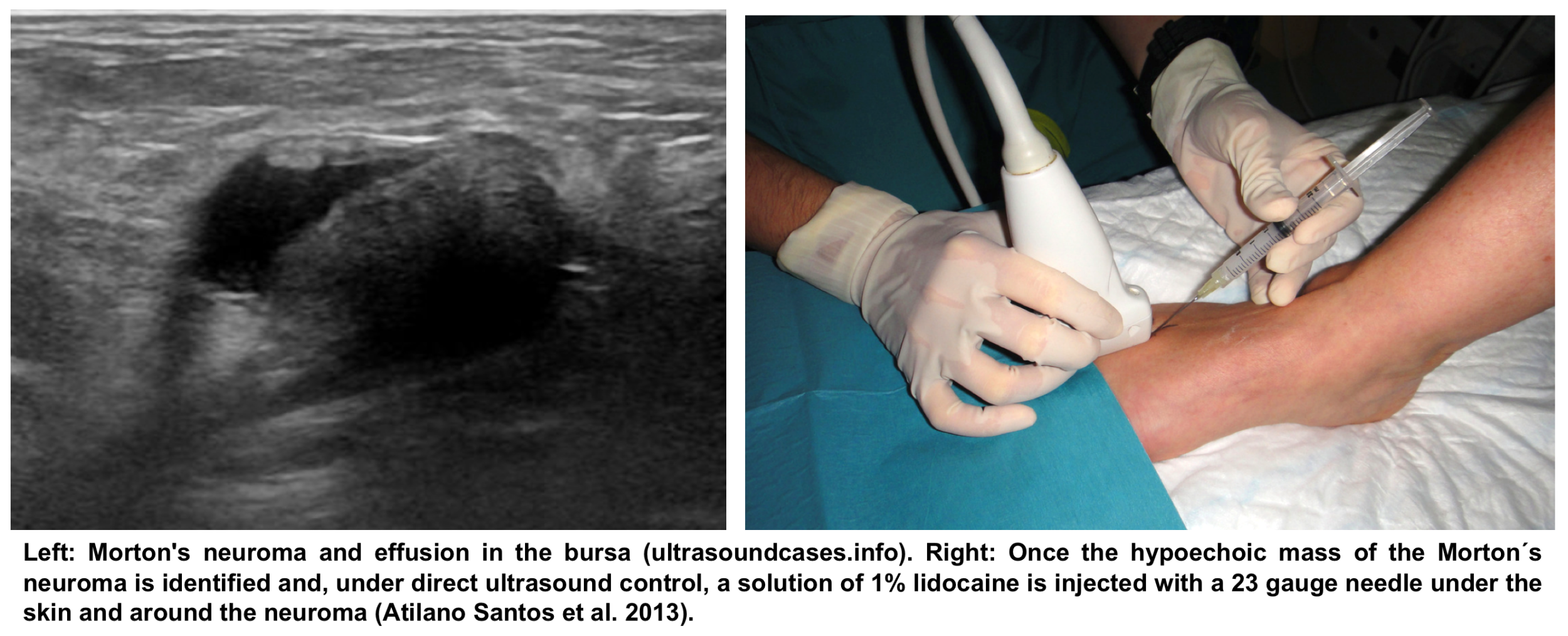 Ultrasound guided injection of Morton's neuroma